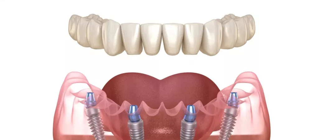 protesirovaniye-pod-narkozom-v-colibri-dental-23.png protesirovaniye-pod-narkozom-v-colibri-dental-23.png