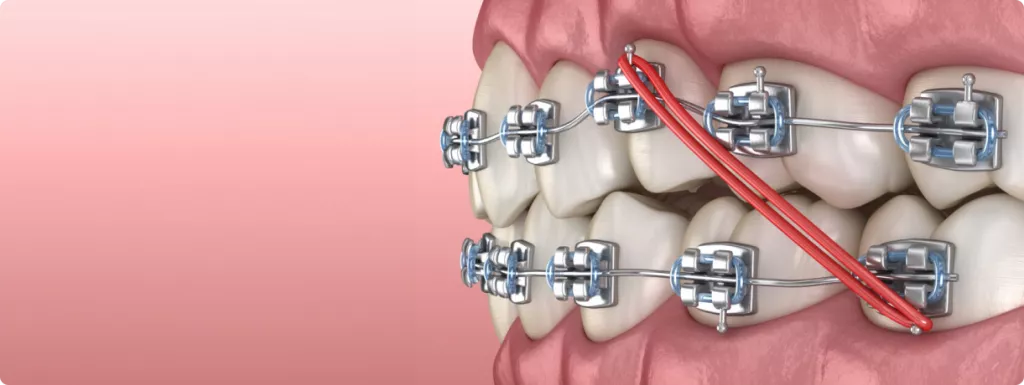 lecheniye-na-breketah-v-colibri-dental.png