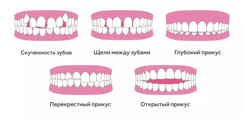 Коллаж элайнеры.png