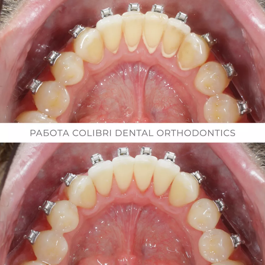 kochetkova-colibri-dental-professionalnaya-chistka-pri-ortodontocheskom-lechenii.png