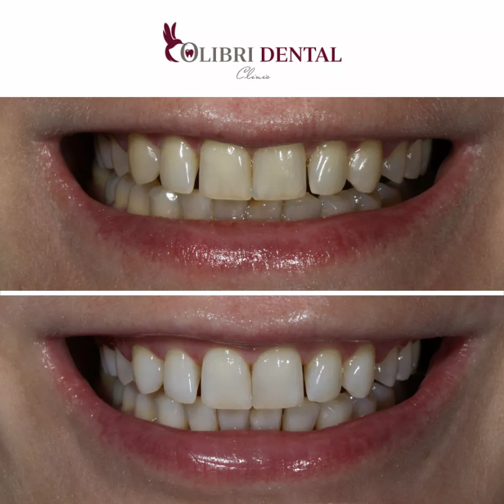 kochetkova-case-colibri-dental.png kochetkova-case-colibri-dental.png