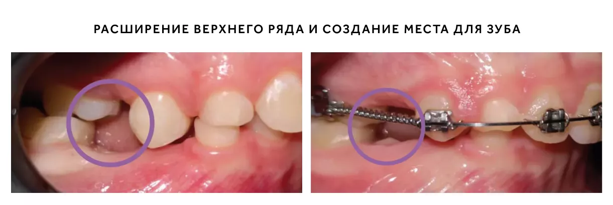 как брекеты раздвигают зубы.png