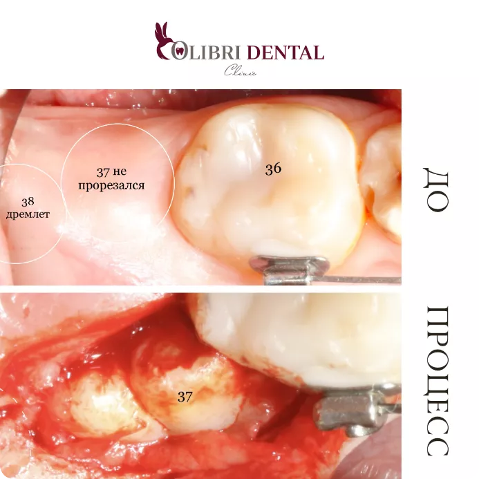 udaleniye-zyubov-colibri-dental-4.png