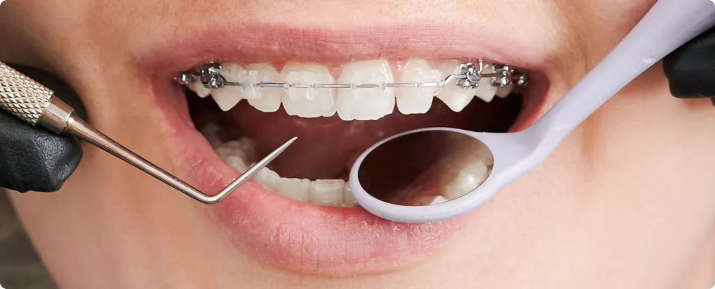 kombinirovanniye-breketi-colibri-dental.png kombinirovanniye-breketi-colibri-dental.png