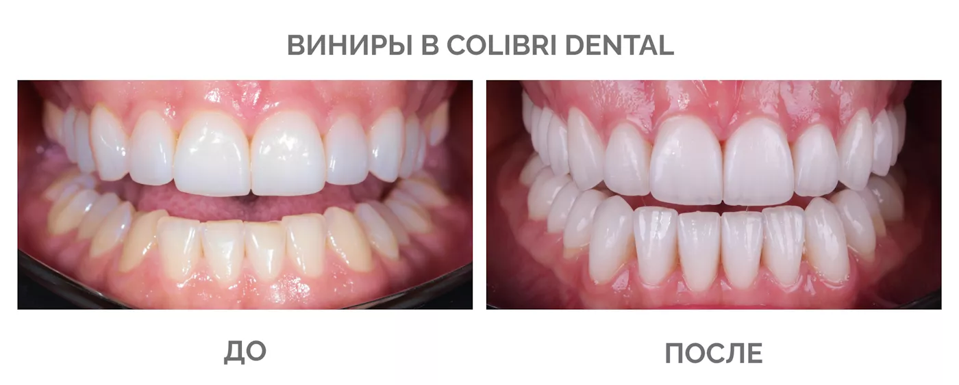 3viniri-v-colibri-dental