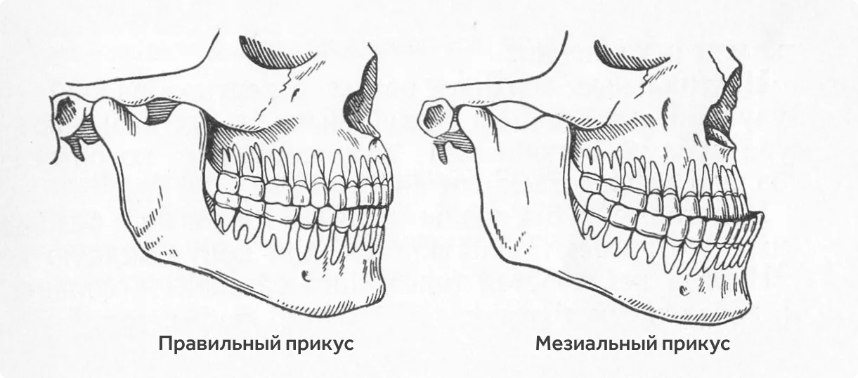 pravilniy-i-mezialniy-prikus