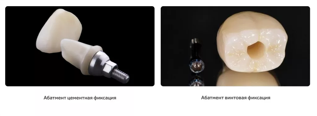 fiksatsiya_koronki_na_implant.png fiksatsiya_koronki_na_implant.png