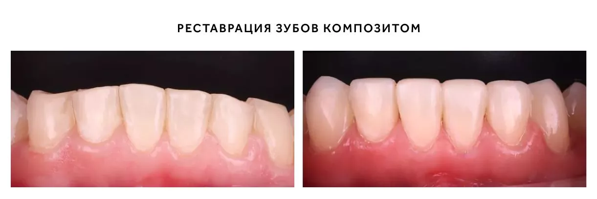 Реставрация передних зубов.jpg