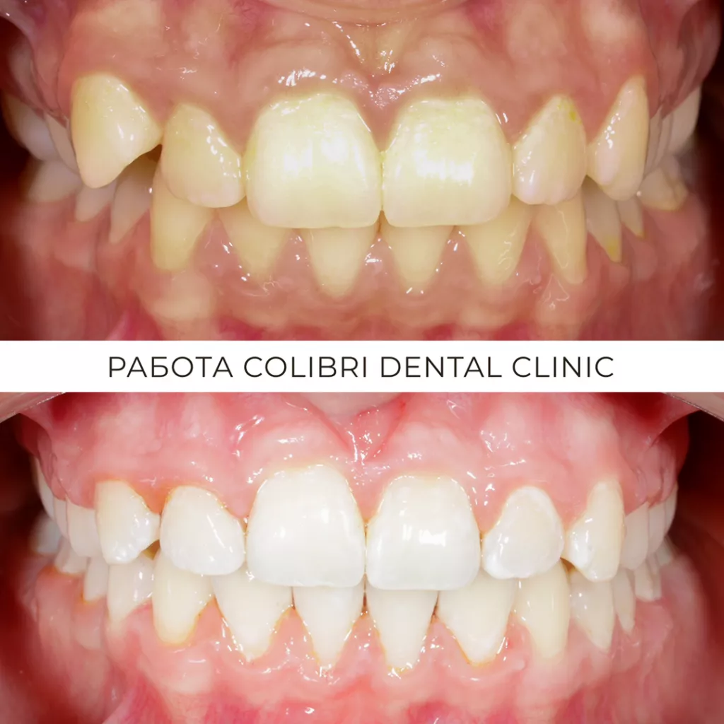ispravleniye-prikusa-lusine-vekilyan-colibri-dental.png ispravleniye-prikusa-lusine-vekilyan-colibri-dental.png