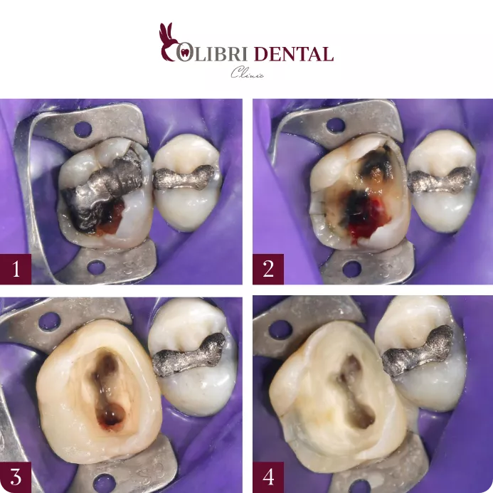 lecheniye-kanalov-colibri-dental.png