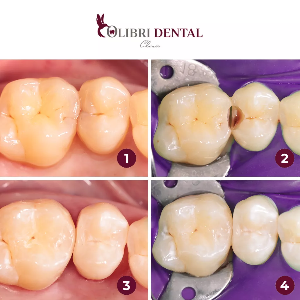 lecheniye-kariyesa-bagdasaryan-colibri-dental-do-posle.png