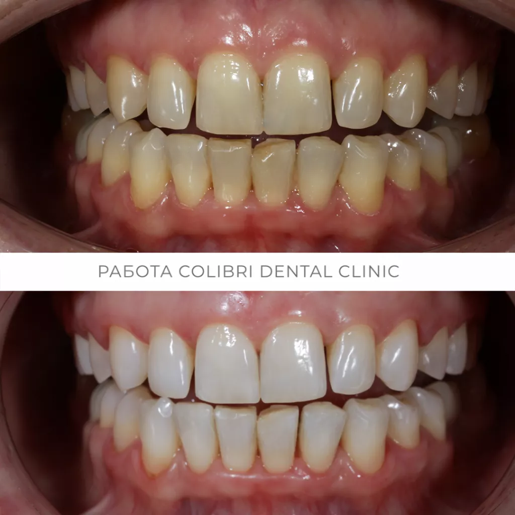 kochetkova-case-colibri-dental-zoom-otbelivaniye.png kochetkova-case-colibri-dental-zoom-otbelivaniye.png