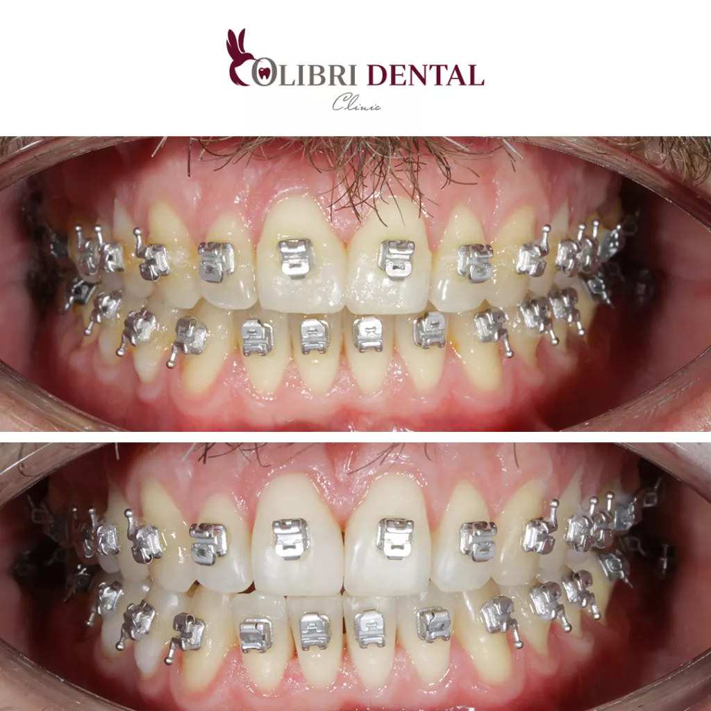 colibri-dental-professionalnaya-chistka-pri-ortodontocheskom-lechenii.png