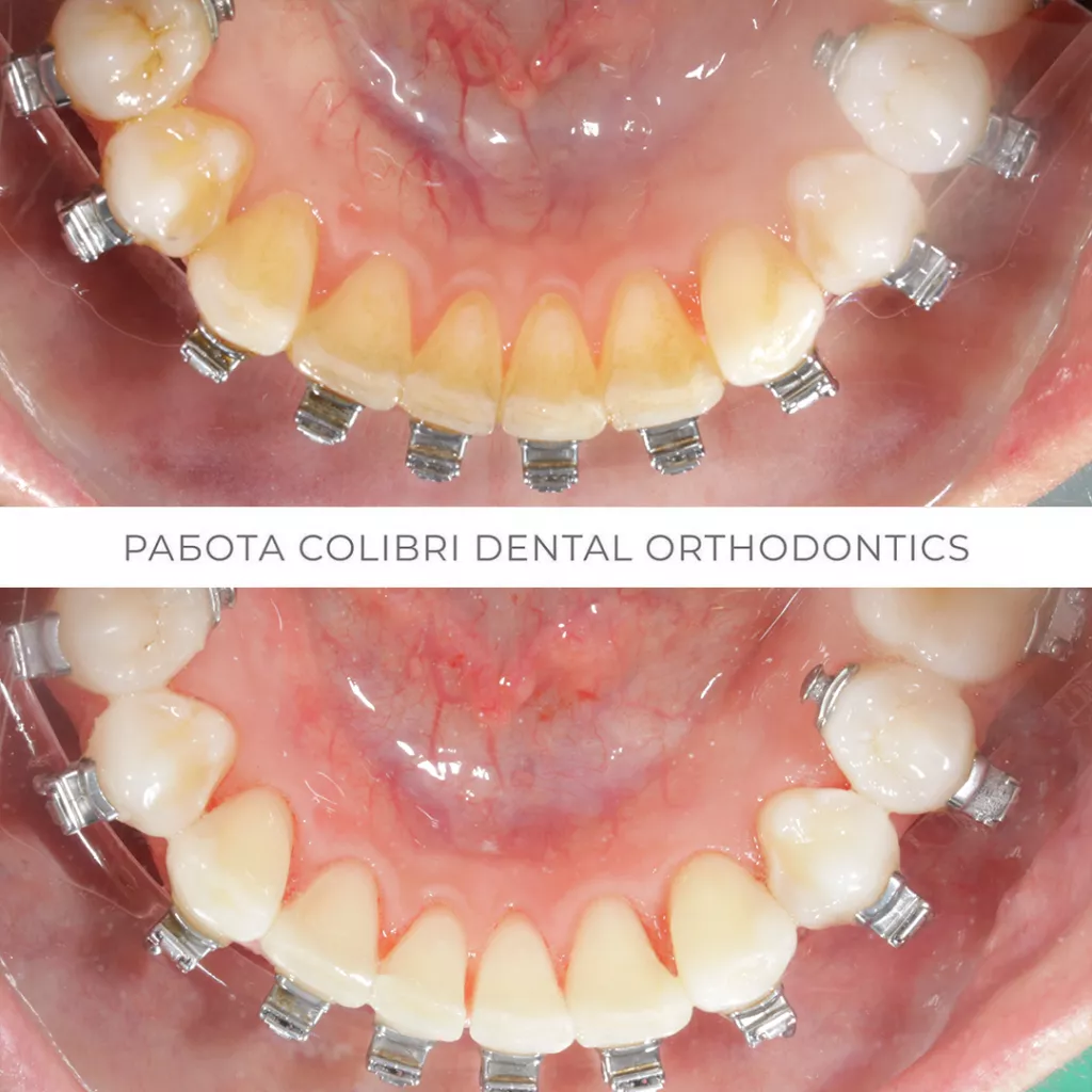 kochetkova-colibri-dental-gigiyenna-pri-ortodonticheskom-lechenii.png