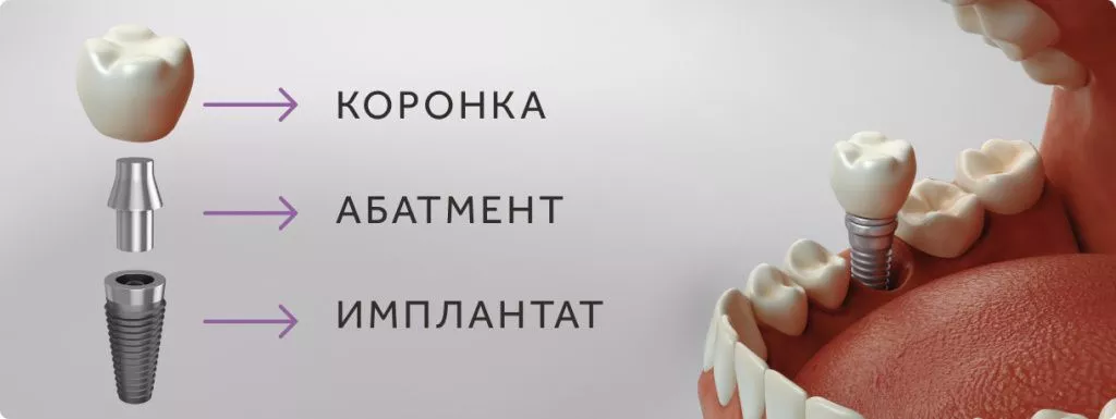 koronka na implantate.jpg