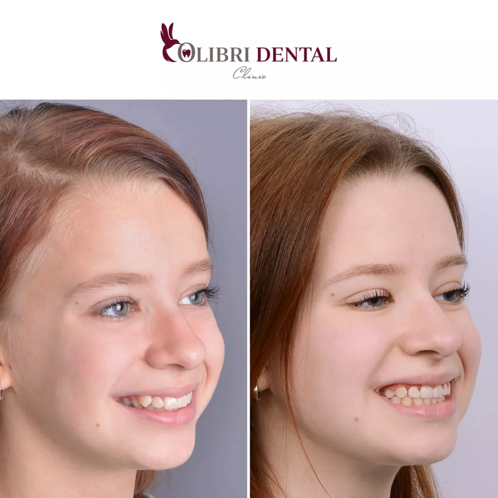 lusine-vekilyan-colibri-dental-ispravleniye-prikusa.png