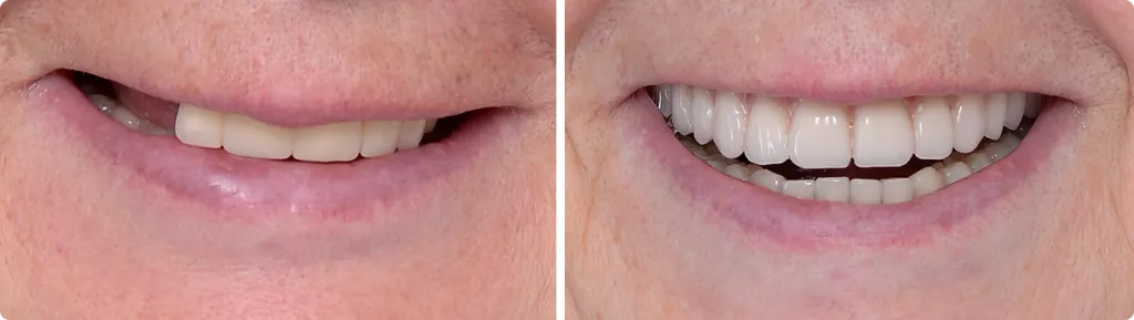 Patient all on 4 before and after.png