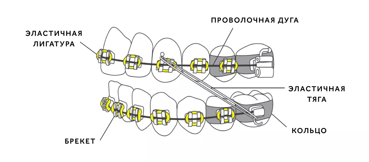 Схема брекетов.png