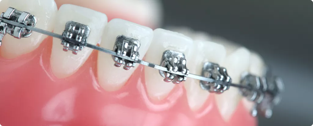 vestibularniye-breketi-colibri-dental.png vestibularniye-breketi-colibri-dental.png