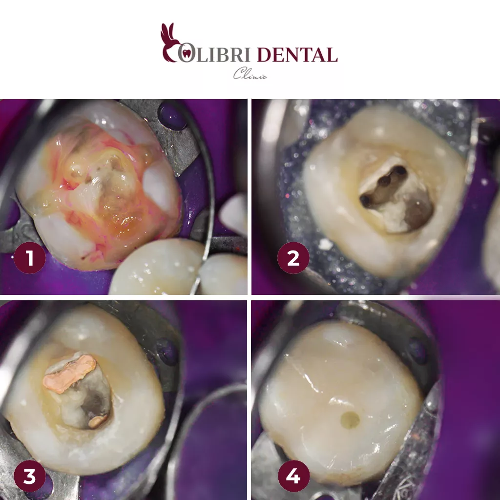 case-1-lecheniye-kariyesa-bagdasaryan-colibri-dental-do-posle.png