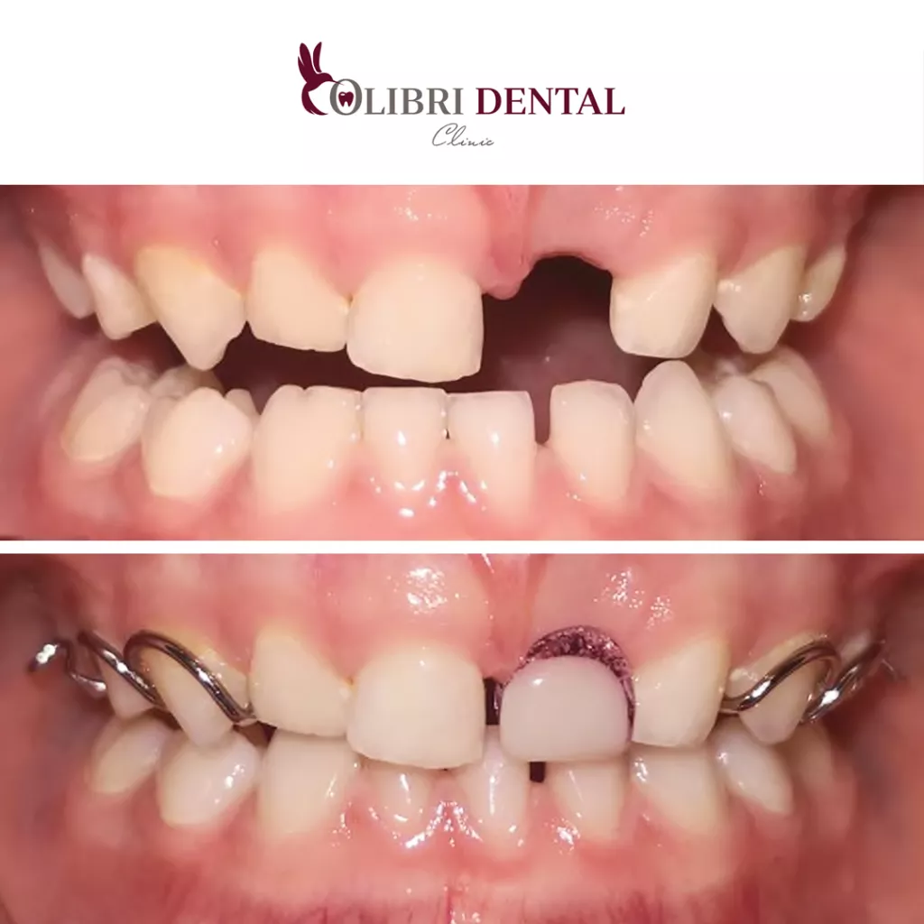 cases-colibri-dental-detskaya-ortodontiya.png