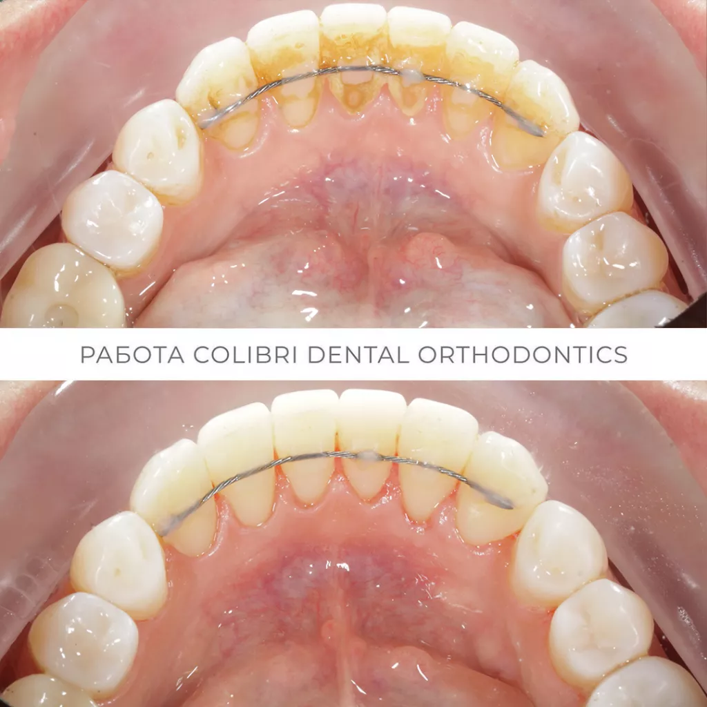 kochetkova-gigiyena-posle-ortodontii-colibri-dental.png