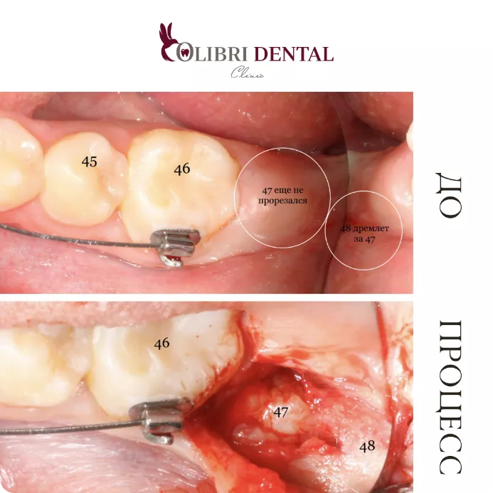 udaleniye-zyubov-colibri-dental-2.png