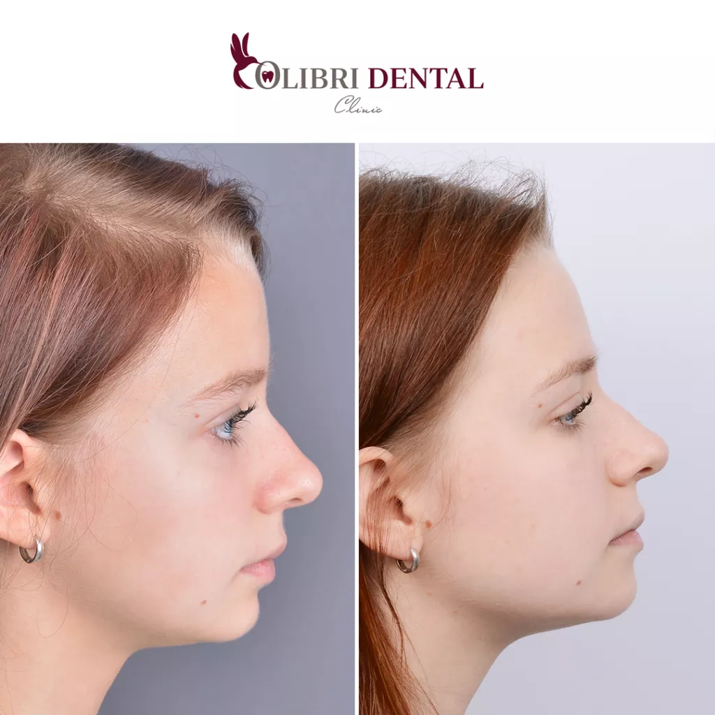 lusine-vekilyan-colibri-dental-do-posle.png lusine-vekilyan-colibri-dental-do-posle.png