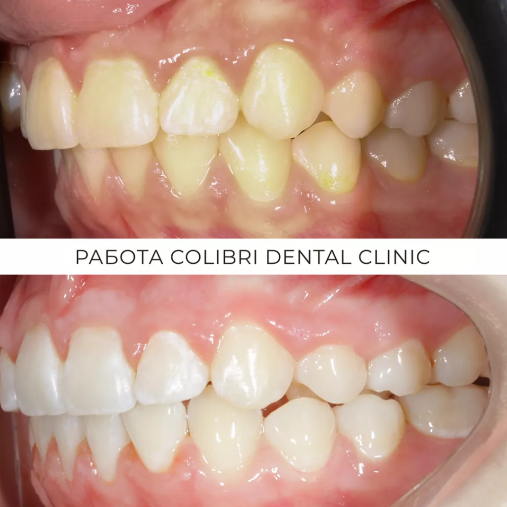 cases-do-posle-colibri-dental-lusine.png cases-do-posle-colibri-dental-lusine.png