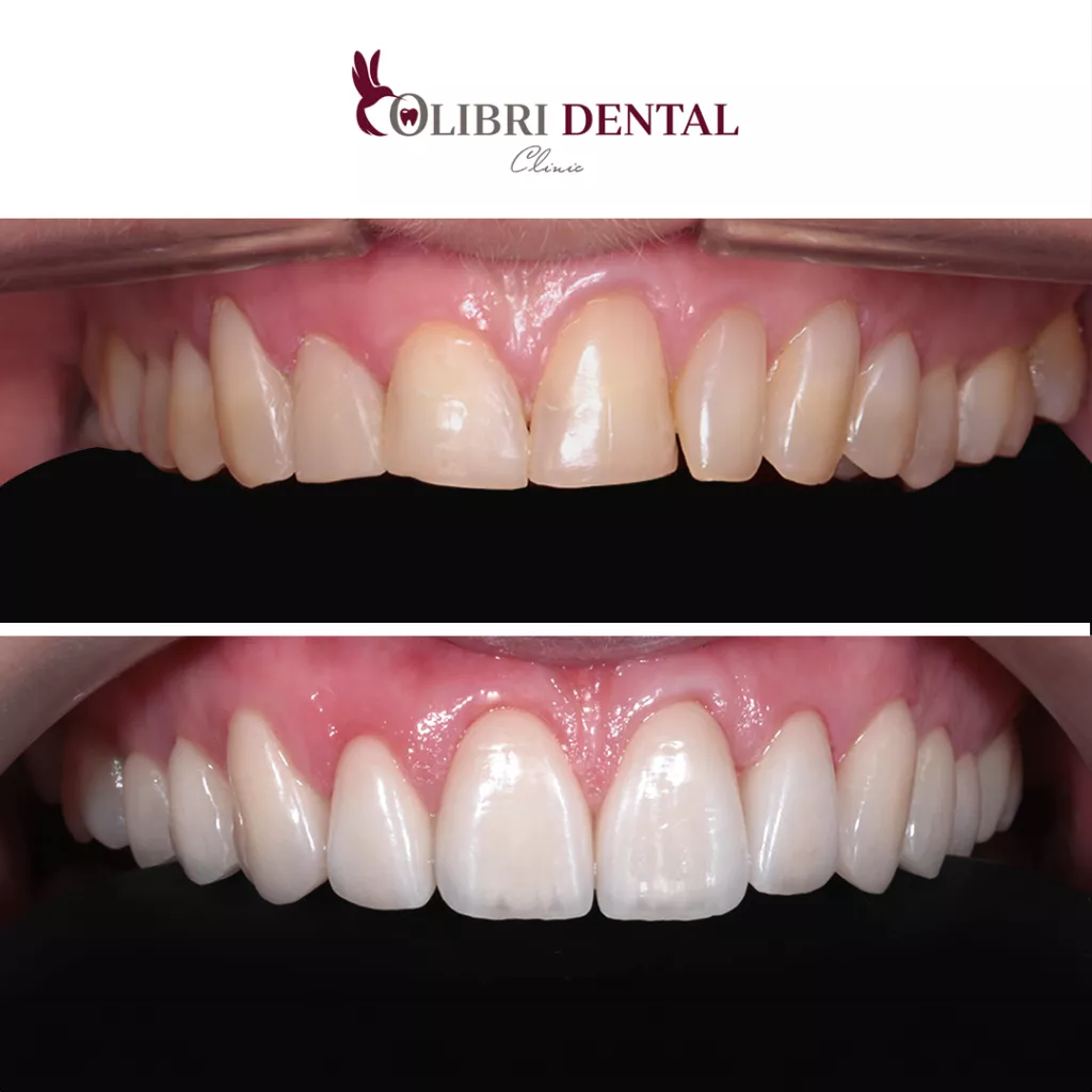 ustanovka-vinirov-colibri-dental-dr-kashmina.png