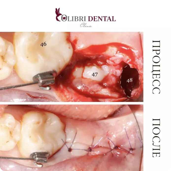 udaleniye-zyubov-colibri-dental-3.png