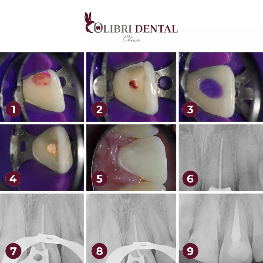 bagdasaryan-colibri-dental-lecheniye-kanalov-zuba.png