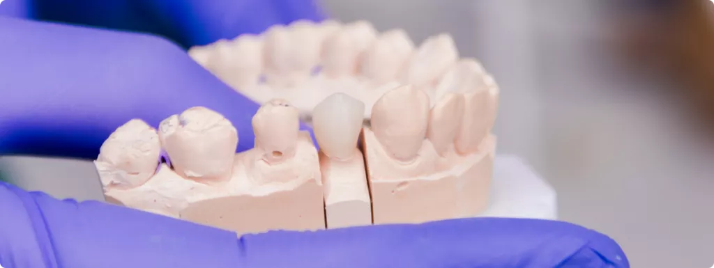 protezirovaniye-v-colibri-dental (1).png
