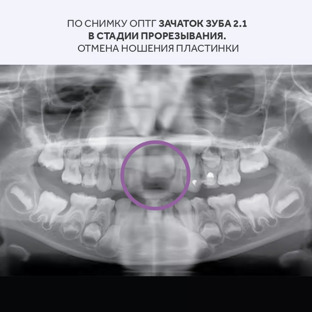 colibri-dental-detskaya-ortodontiya.png