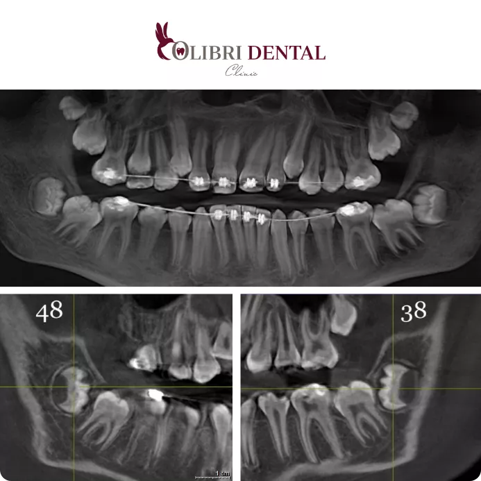 udaleniye-zyubov-colibri-dental-1.png