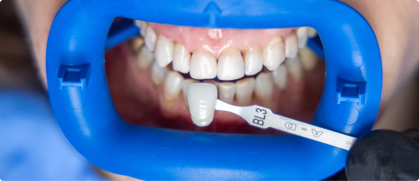 3otbelivaniye-zubov-zoom-4-colibri-dental.png