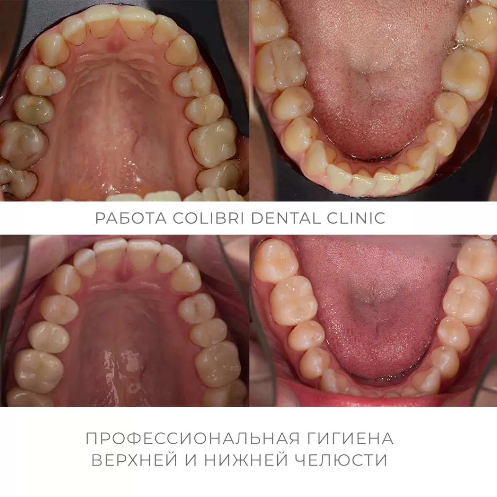 professionalnaya-gigiyena-colibridental.png professionalnaya-gigiyena-colibridental.png