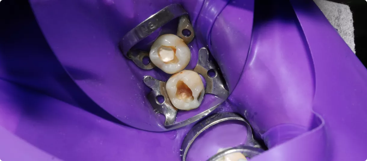 kafferdam-v-colibri-dental.png
