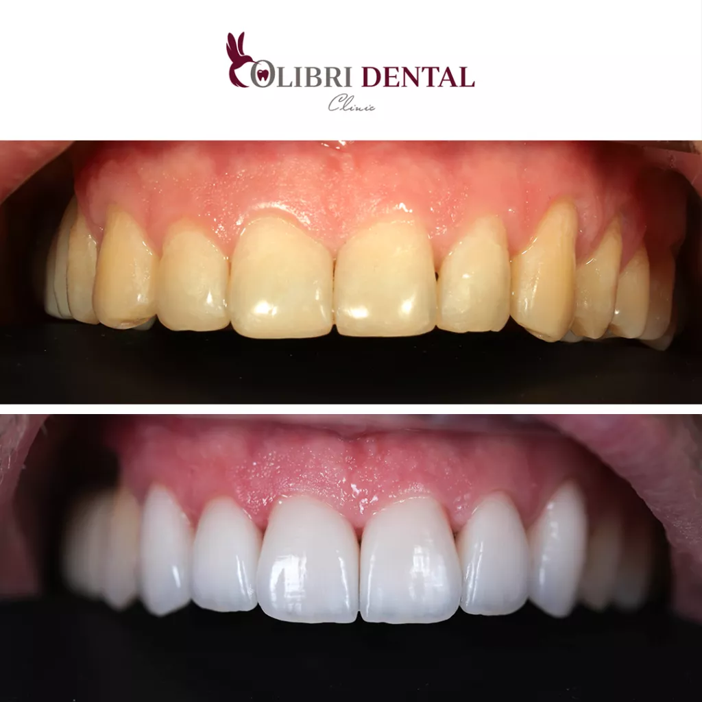 viniri-golivudksaya-ulibka-v-colibri-dental.png