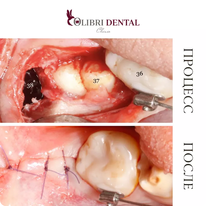 udaleniye-zyubov-colibri-dental-5.png