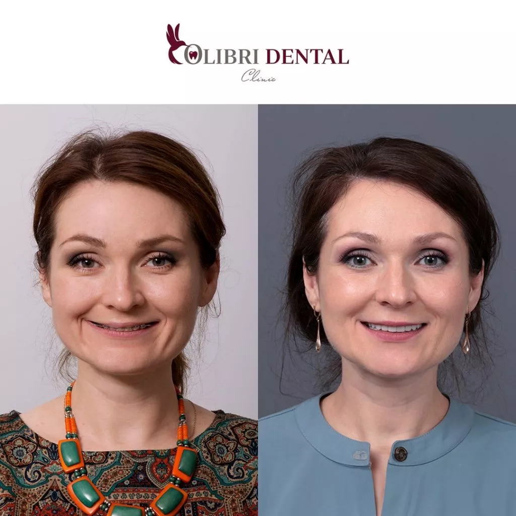cases-colibri-dental-lusine-i-dr-zyubin.jpg