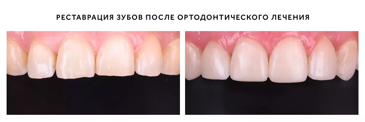Реставрация после ортодонтии.png