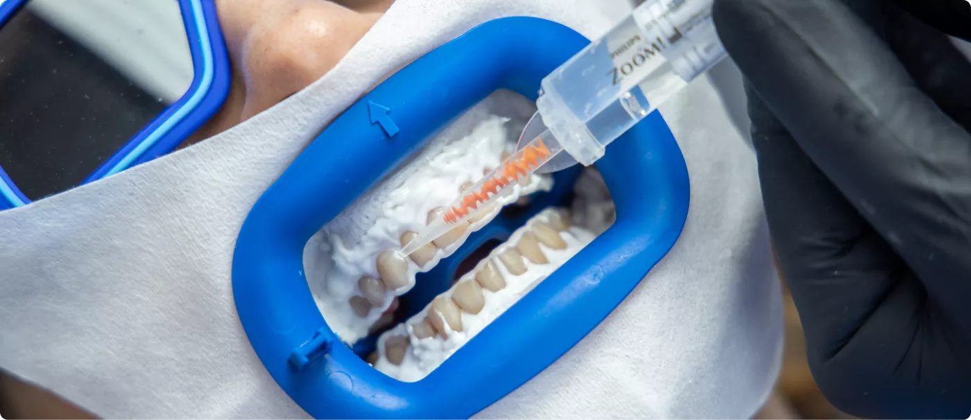 otbelivaniye-zubov-colibri-dental.png