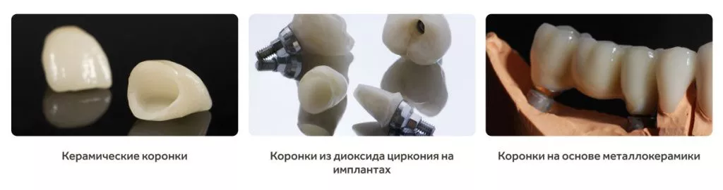 Протезы на передние зубы.jpg
