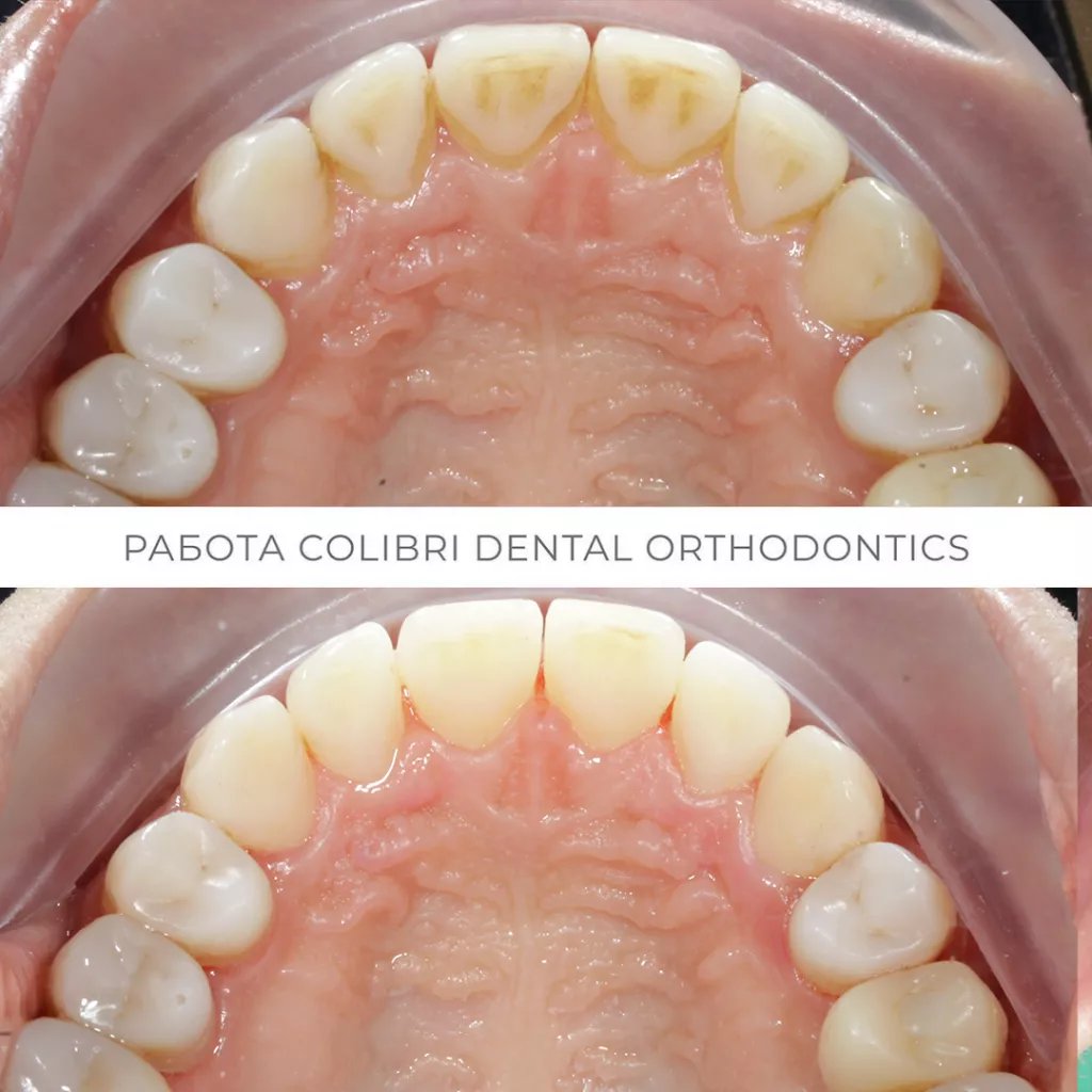 case-gigiyena-posle-ortodonticheskogo-lecheniya-colibri-dental.png