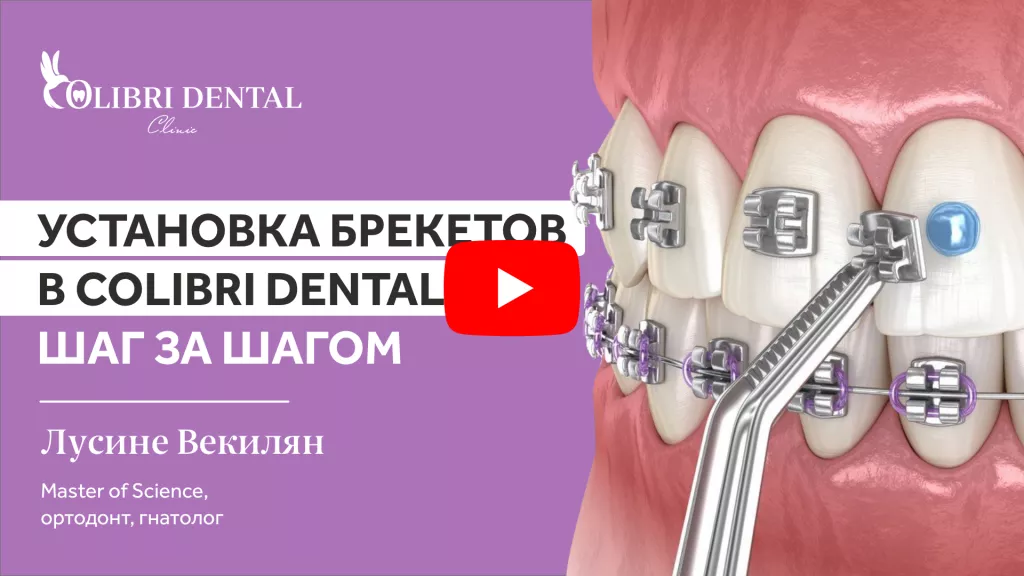 Видео на канале Colibri Dental про установку брекетов