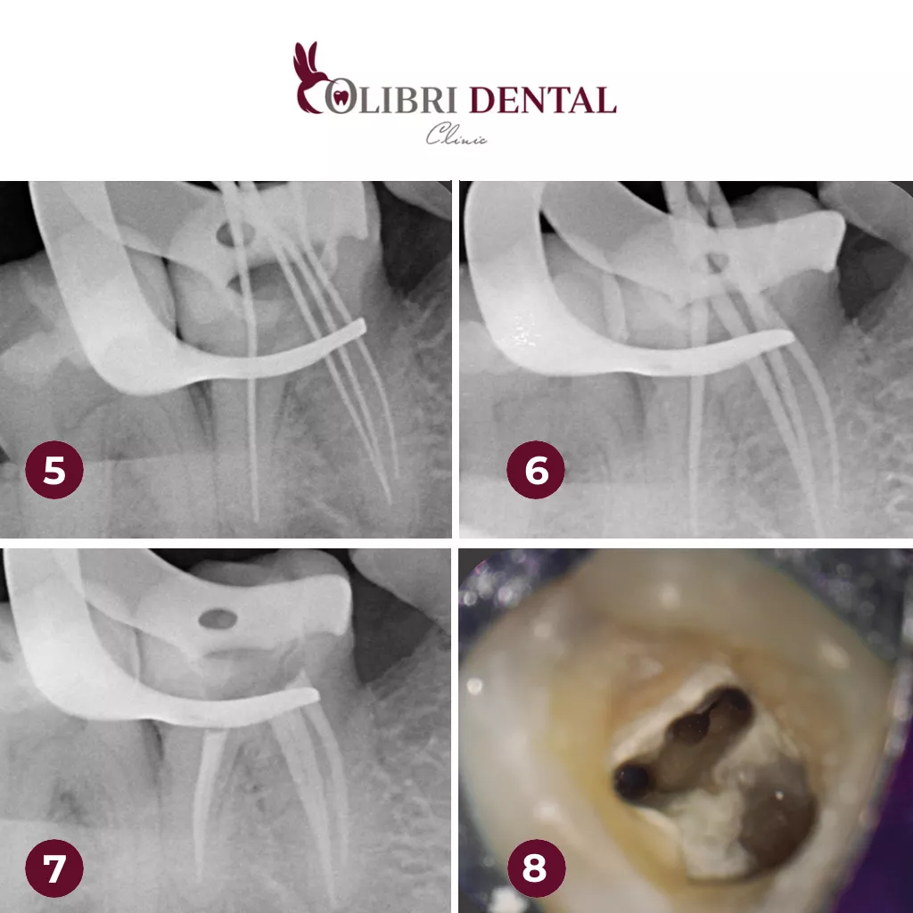 lecheniye-kanalov-bagdasaryan-colibri-dental-do-posle.png