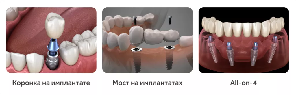 koronka-i-most-na-implantate.png