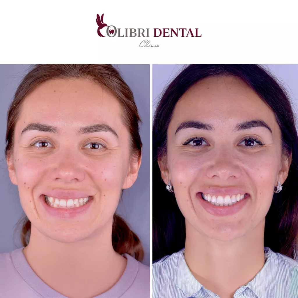 cases-colibri-dental-ispravleniye-prikusa.png