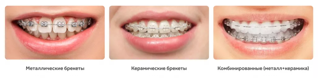 разные брекеты